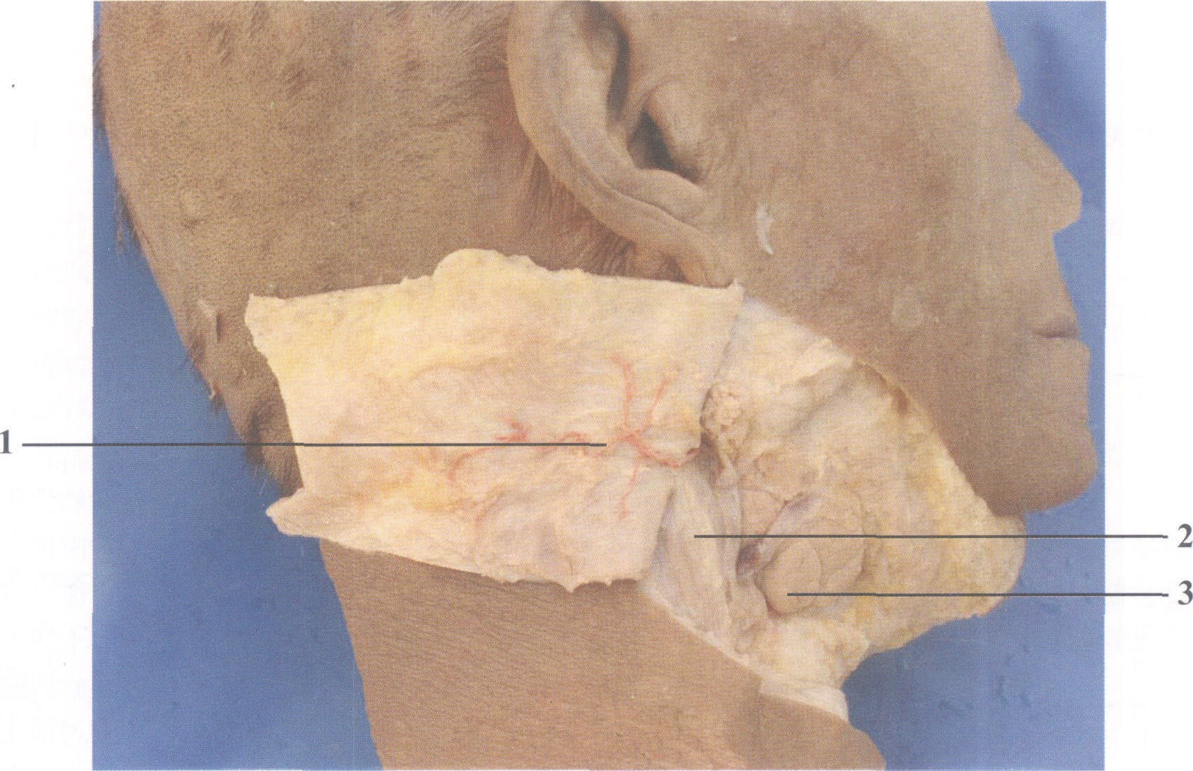 10.颌下腺导管结石取石技巧-口腔科学-医学