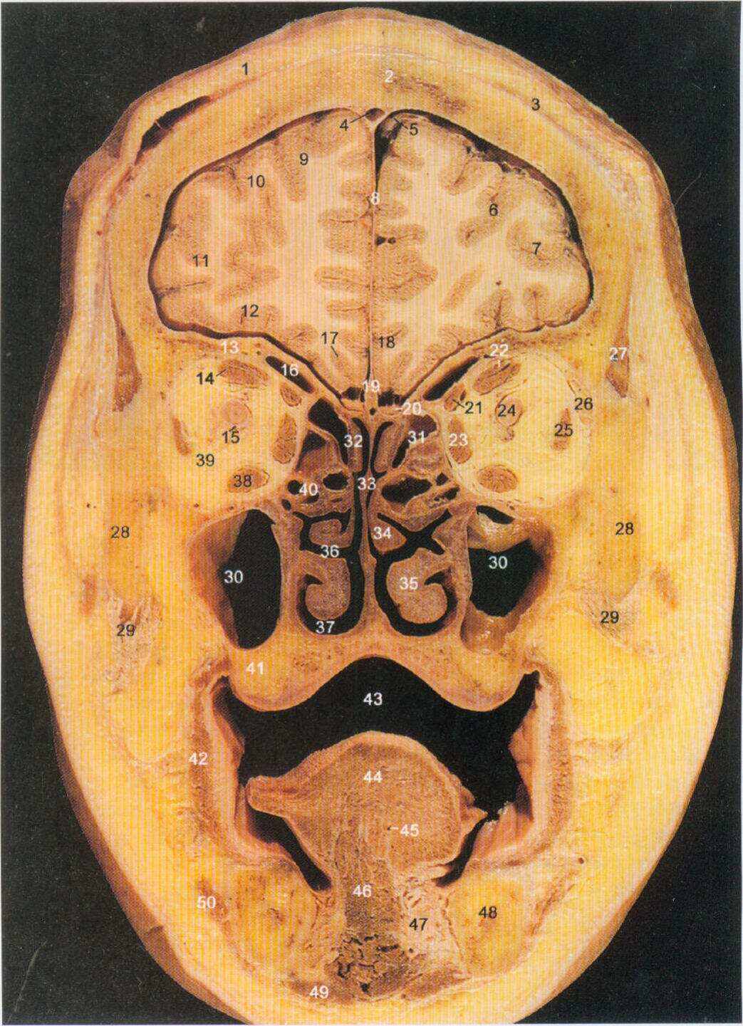 (图) 经筛骨鸡冠的冠状断层