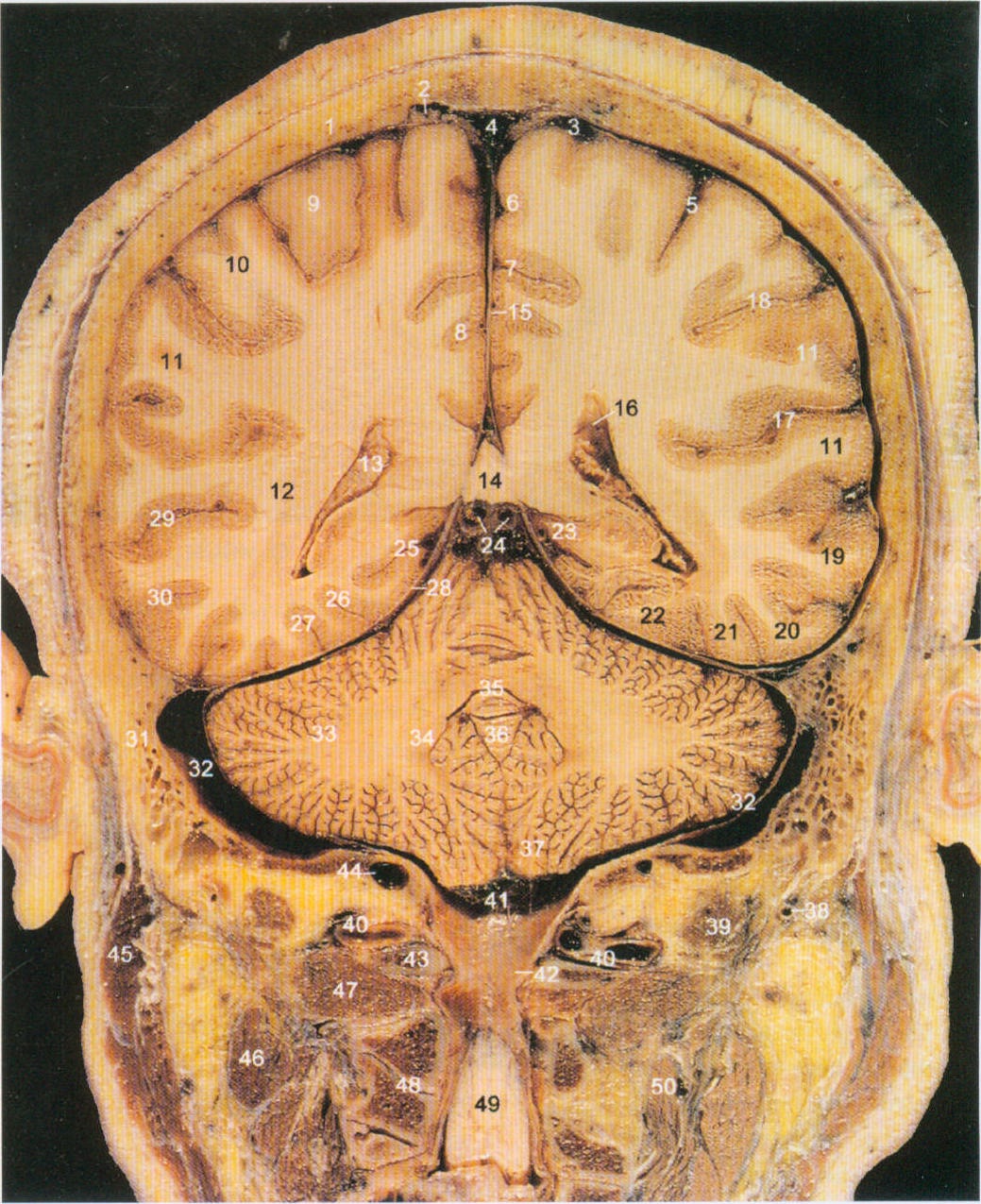 【影诊思维】060新生儿半脑叶型前脑无裂畸形并胼胝体发育不良MR典型影像表现 - 知乎