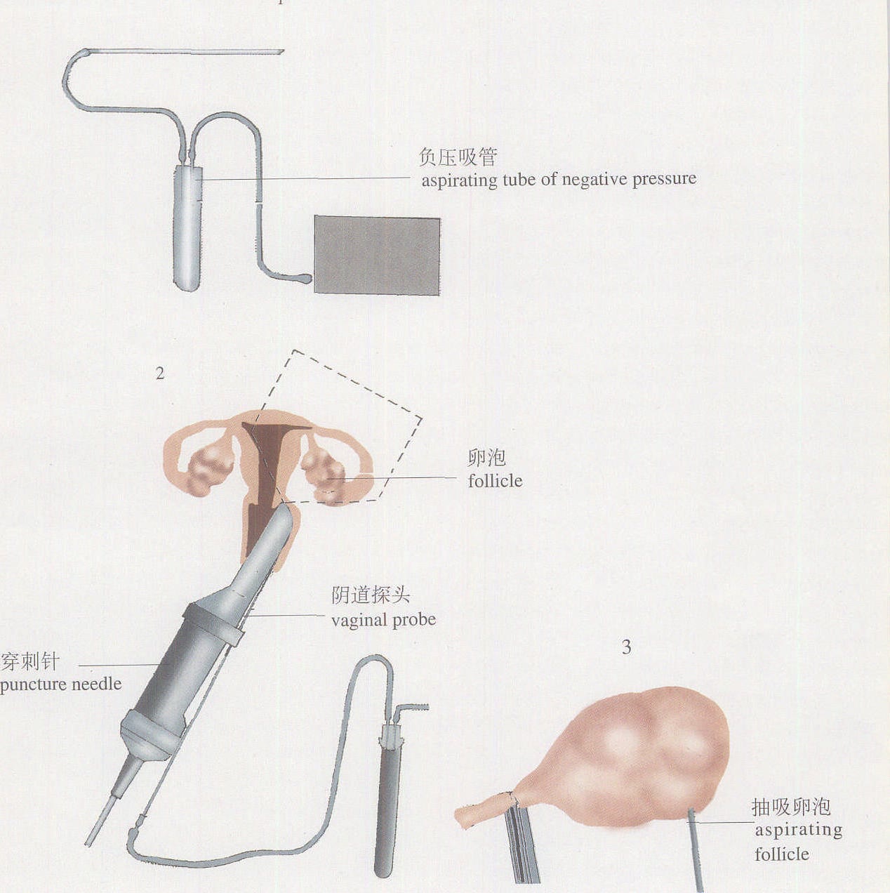 图2-164 阴道形态(2)-妇产科临床解剖学-医学
