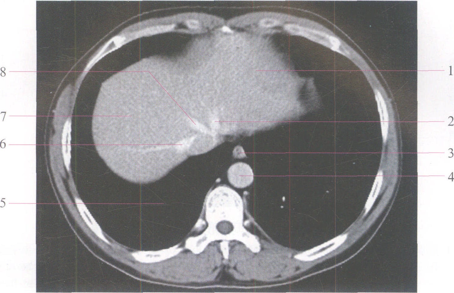 图22-21 经十二指肠水平部的CT横断层图像-腹部外科临床解剖学-医学