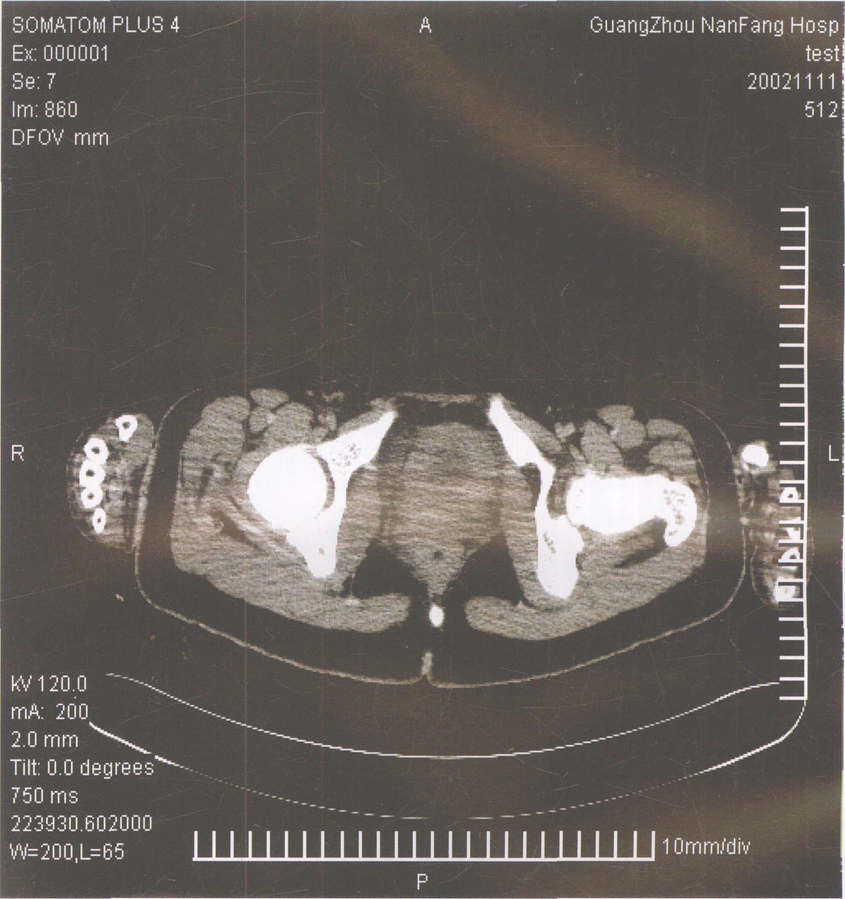 病例6-77 盆腔脓肿(2)-超声读片-医学