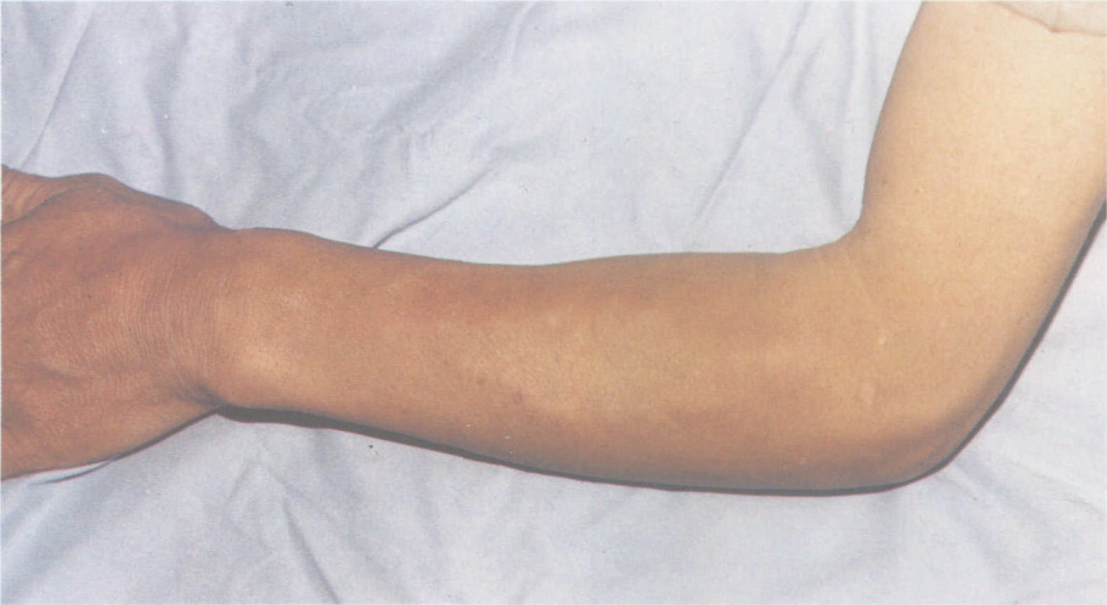 226.SLE手掌部血管炎:Osler结节和Janeway斑-现代风湿性疾病·-医学