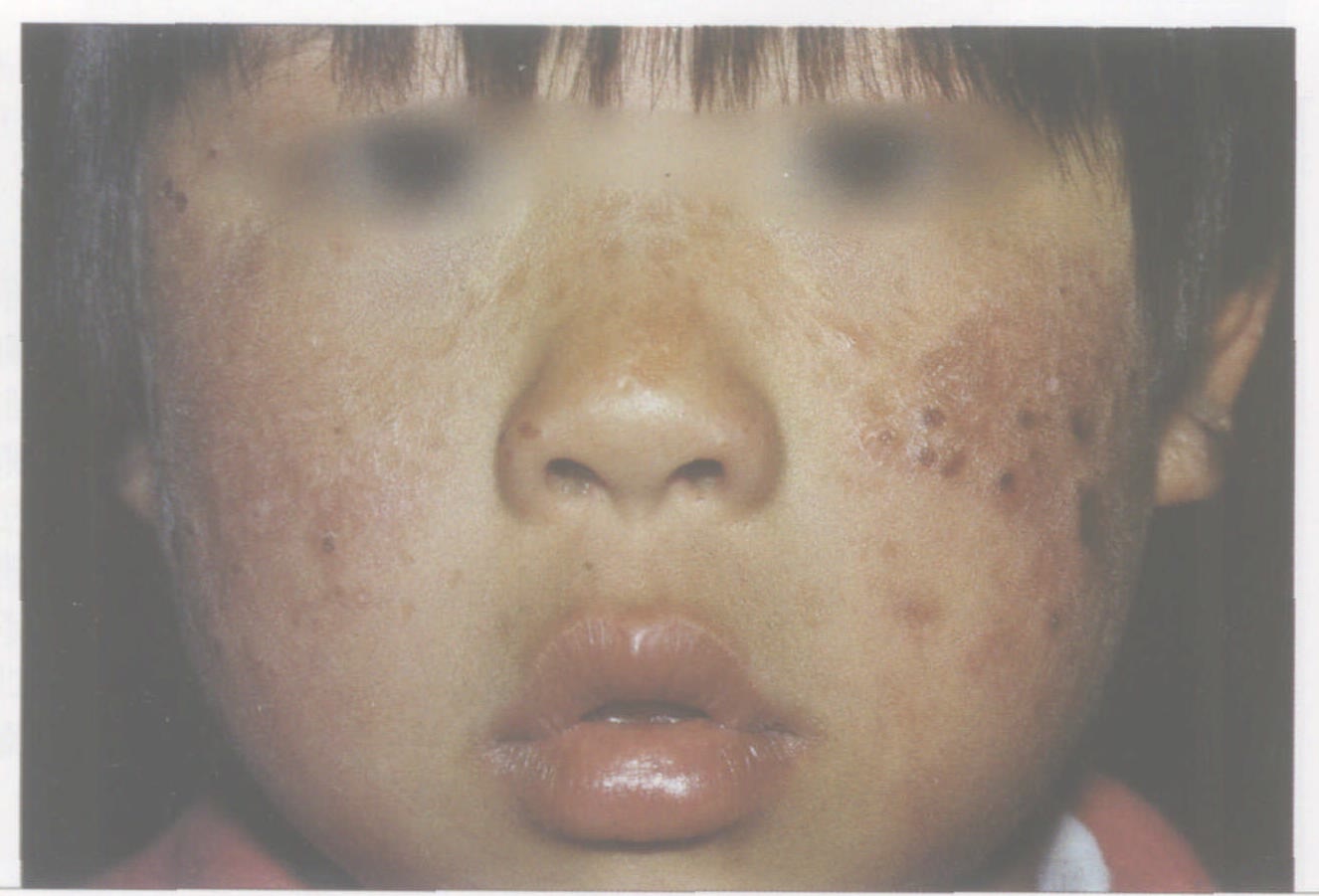婴儿面部脓疱疮与皮肤感染插画图片素材_ID:427365295-Veer图库