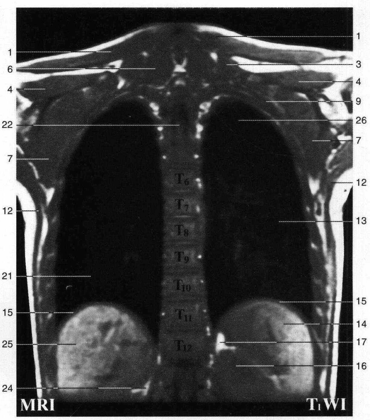 斜方肌trapezius2.菱形肌rhomboideus3.肩胛提肌levatorscapulae4.