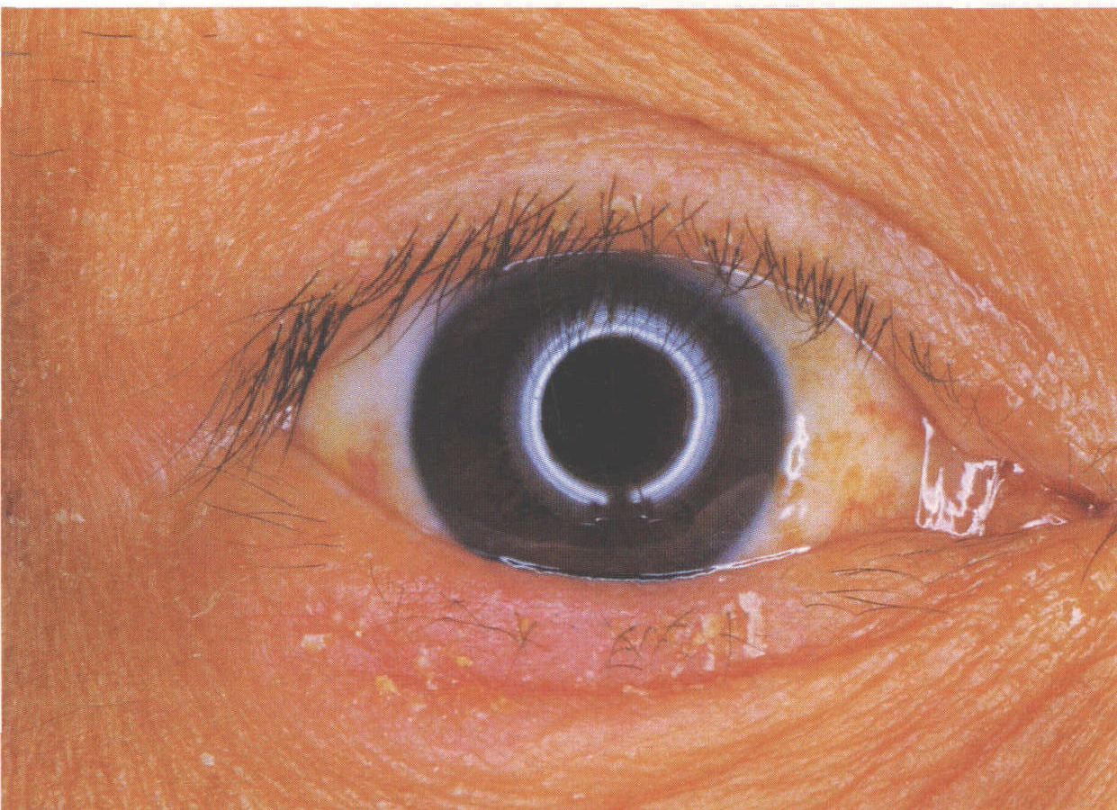 眼睑带状疱疹及引起的病毒性角膜炎的经验治疗_带状疱疹_介绍_治疗方式 - 好大夫在线