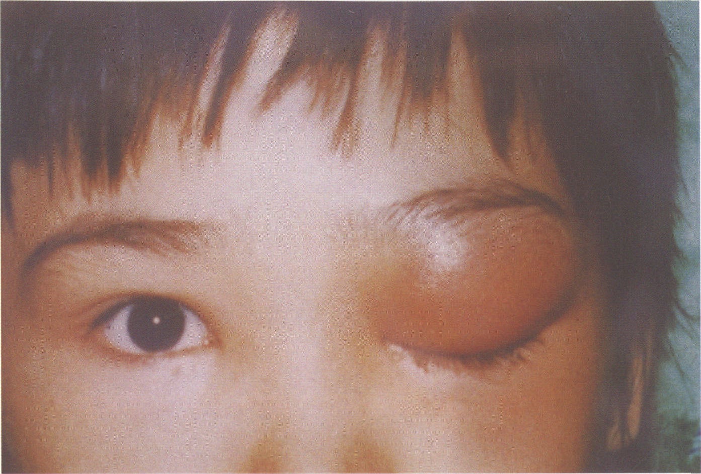 图1-10 双侧麦粒肿。下睑红肿-眼前节疾病-医学