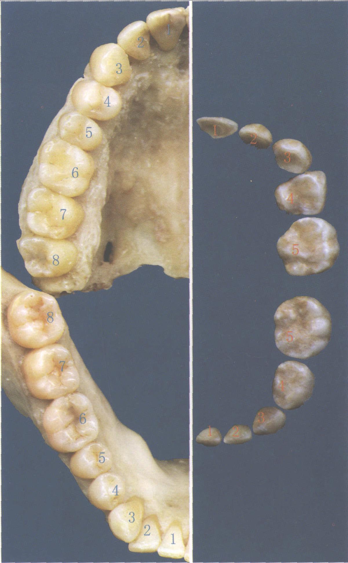 補牙肉手術拯救牙齦萎縮 提升植牙成功率 - 米羅牙醫診所