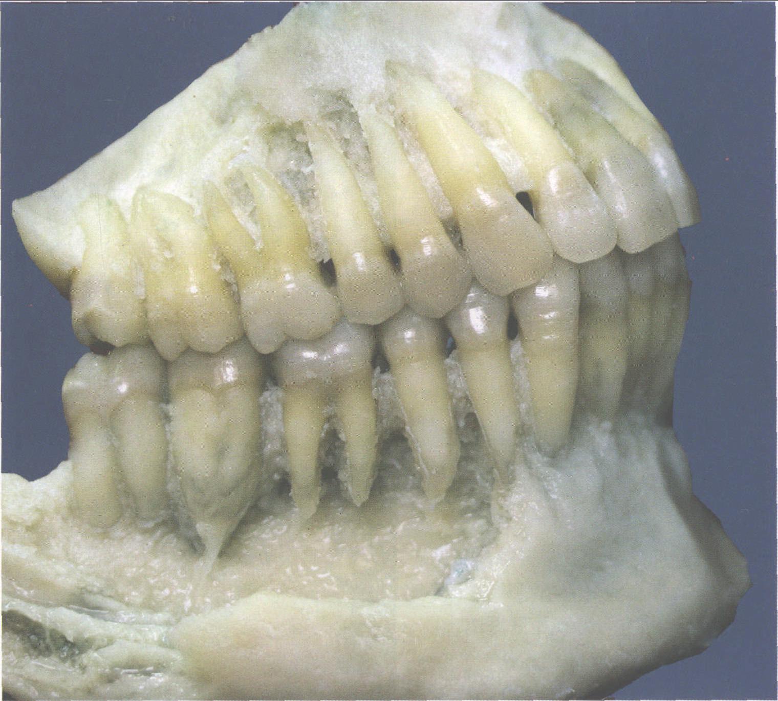 上颌侧切牙外形-口腔解剖学图谱-医学