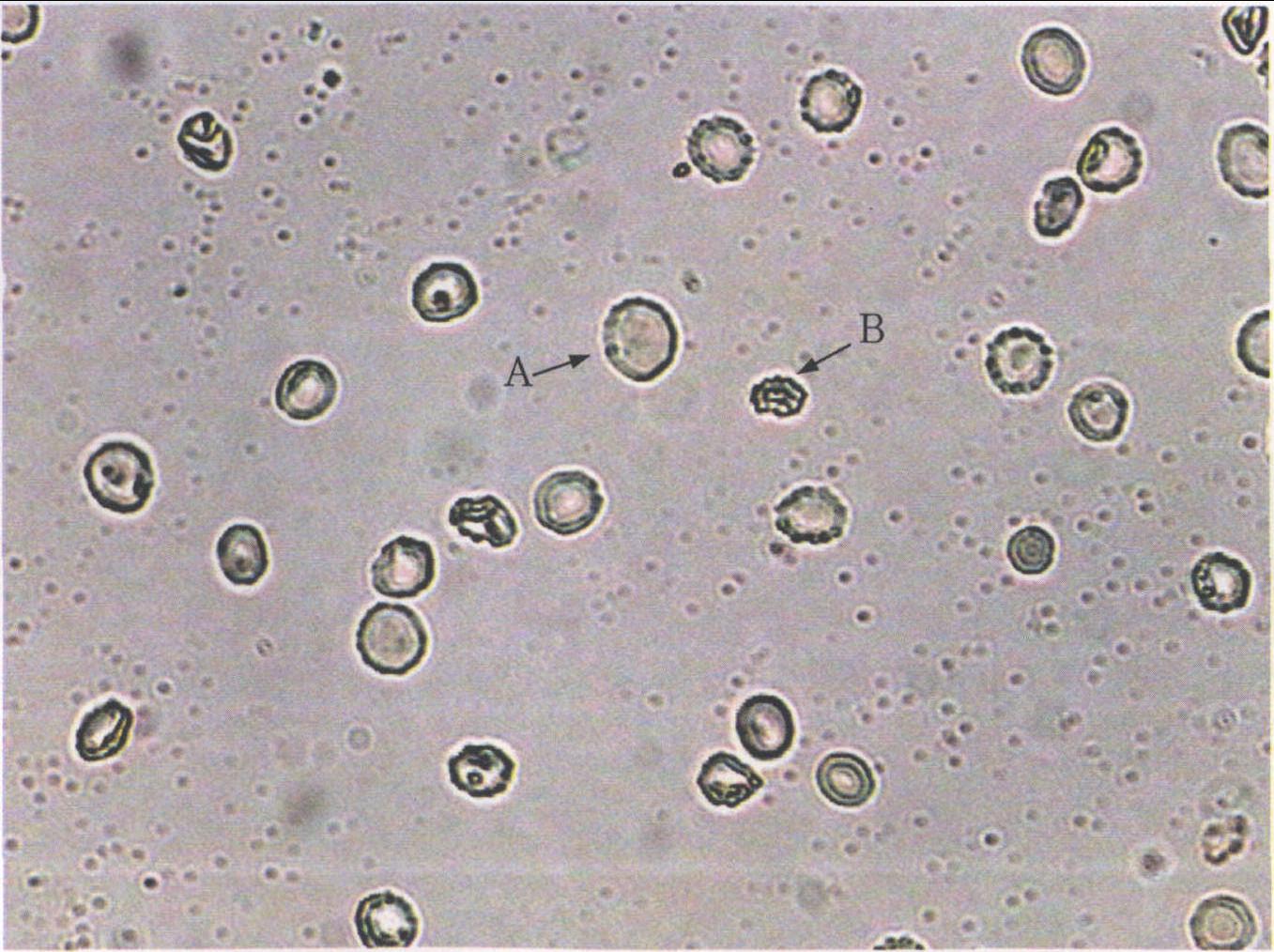 图3-4-7 白细胞管型-尿液沉渣实录-医学