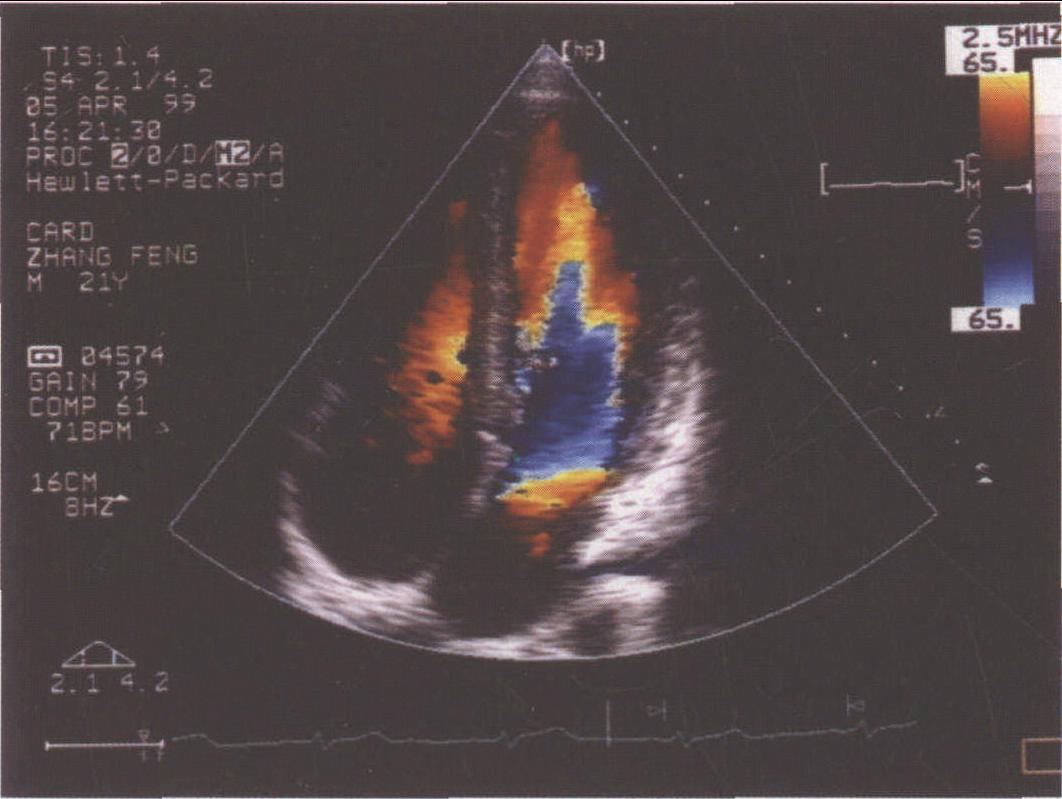窦性心律及窦性心律失常的心电散点图 - 心血管 - 天山医学院