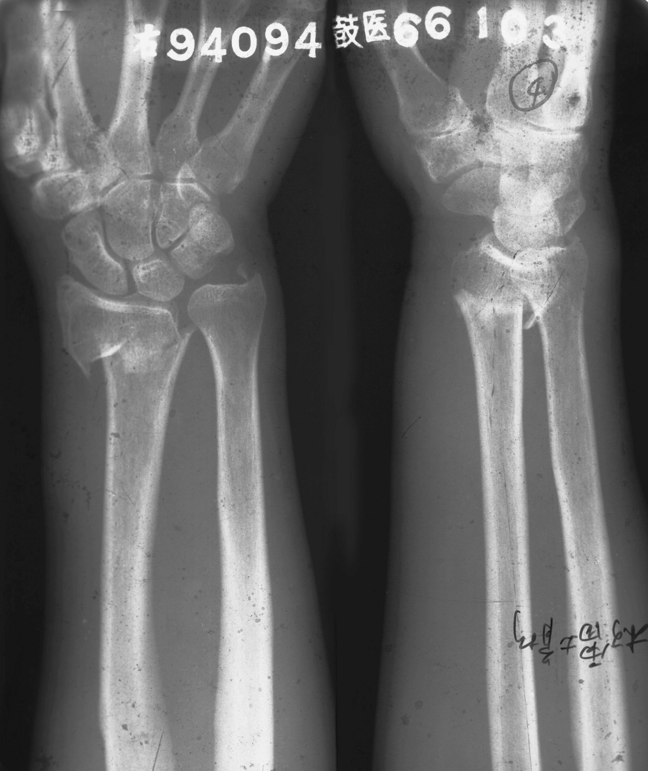 病例22 桡骨远端伸直型骨折