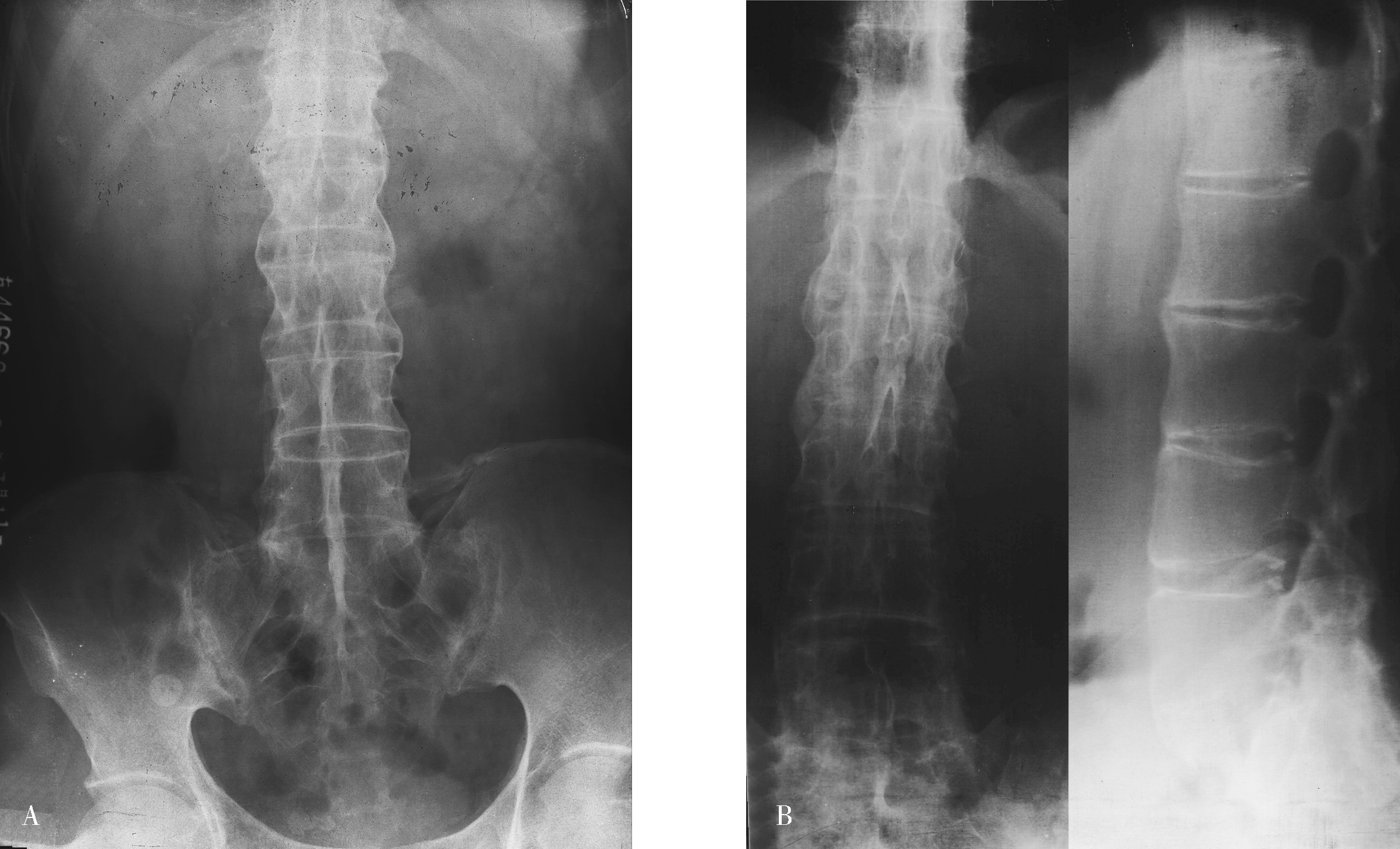 脊柱畸形的X线摄片方法，看完这篇你就掌握！ - 好医术早读文章 - 好医术-赋能医生守护生命