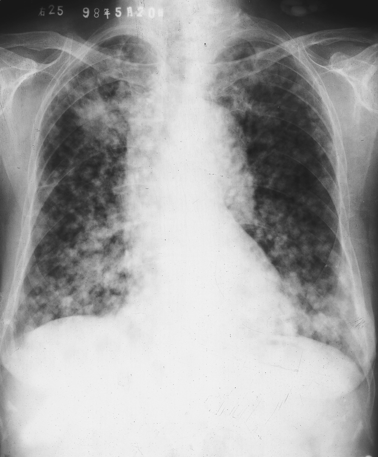 刘敏：病毒性肺炎的CT影像学特征分析｜权威在线（8）-头条-呼吸界