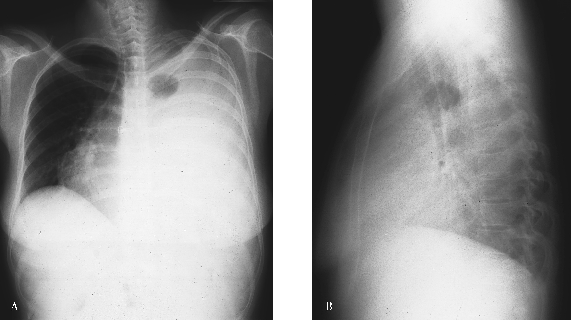 图2—587 心包积液-胸部X线影像学图鉴-医学