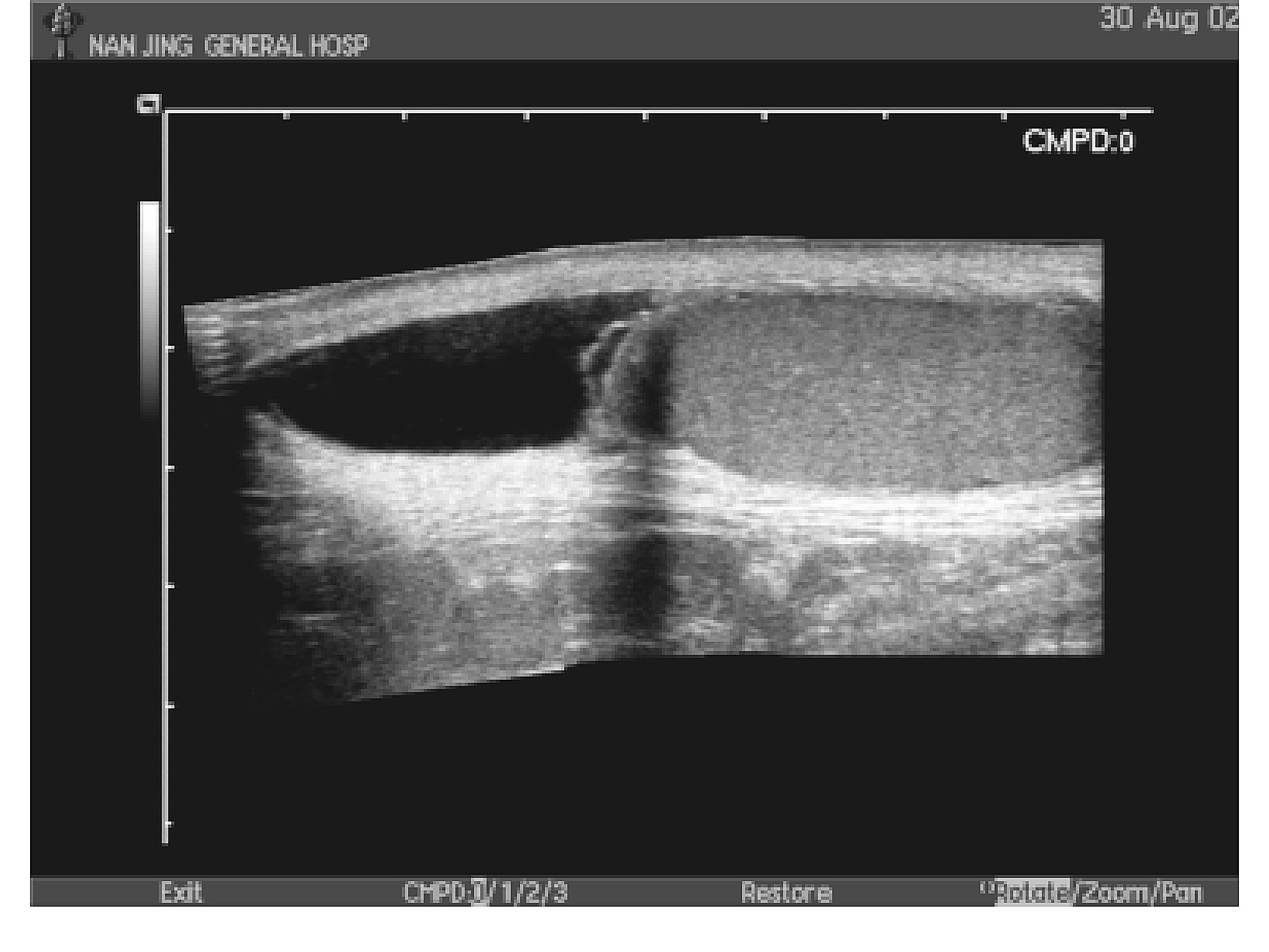 图23-32 经下腔静脉和肝门静脉的MRI矢状断层图像-外科学-医学