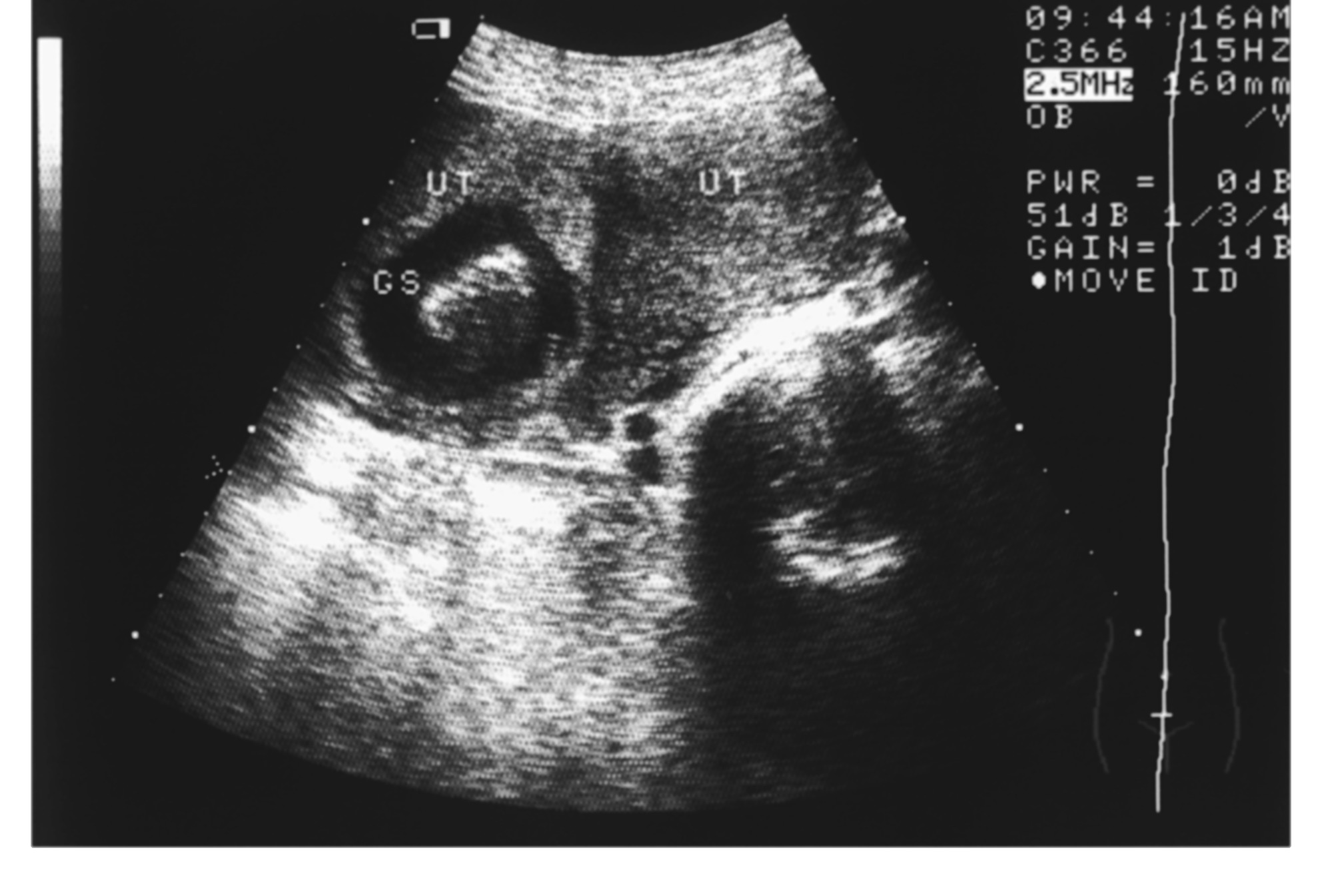 妊娠期阴道微生态特点 - 知乎