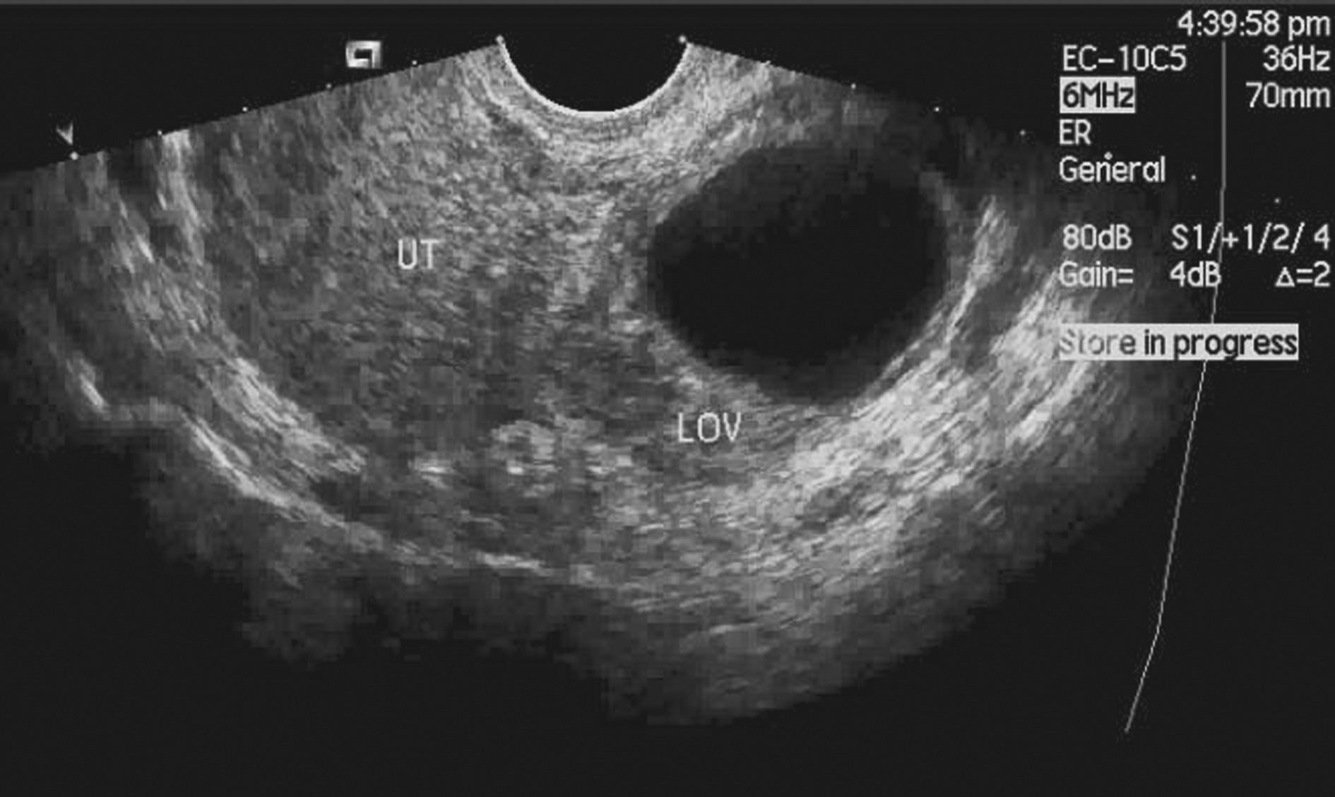 卵巢囊肿的超声声像图表现