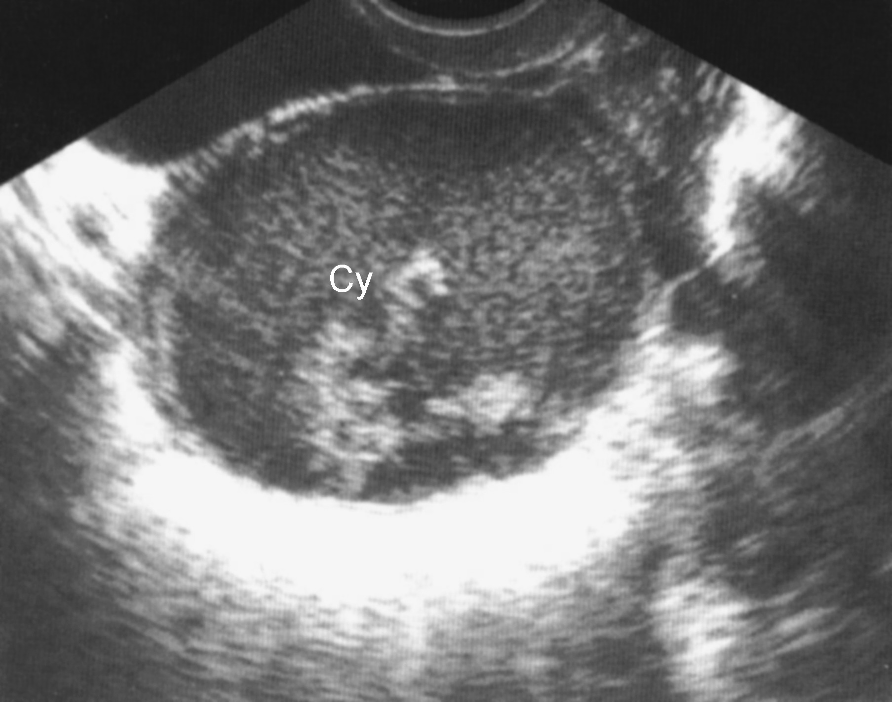 妇科医生提醒：卵巢囊肿的5大征兆，有这些征兆出现的要注意！ - 知乎