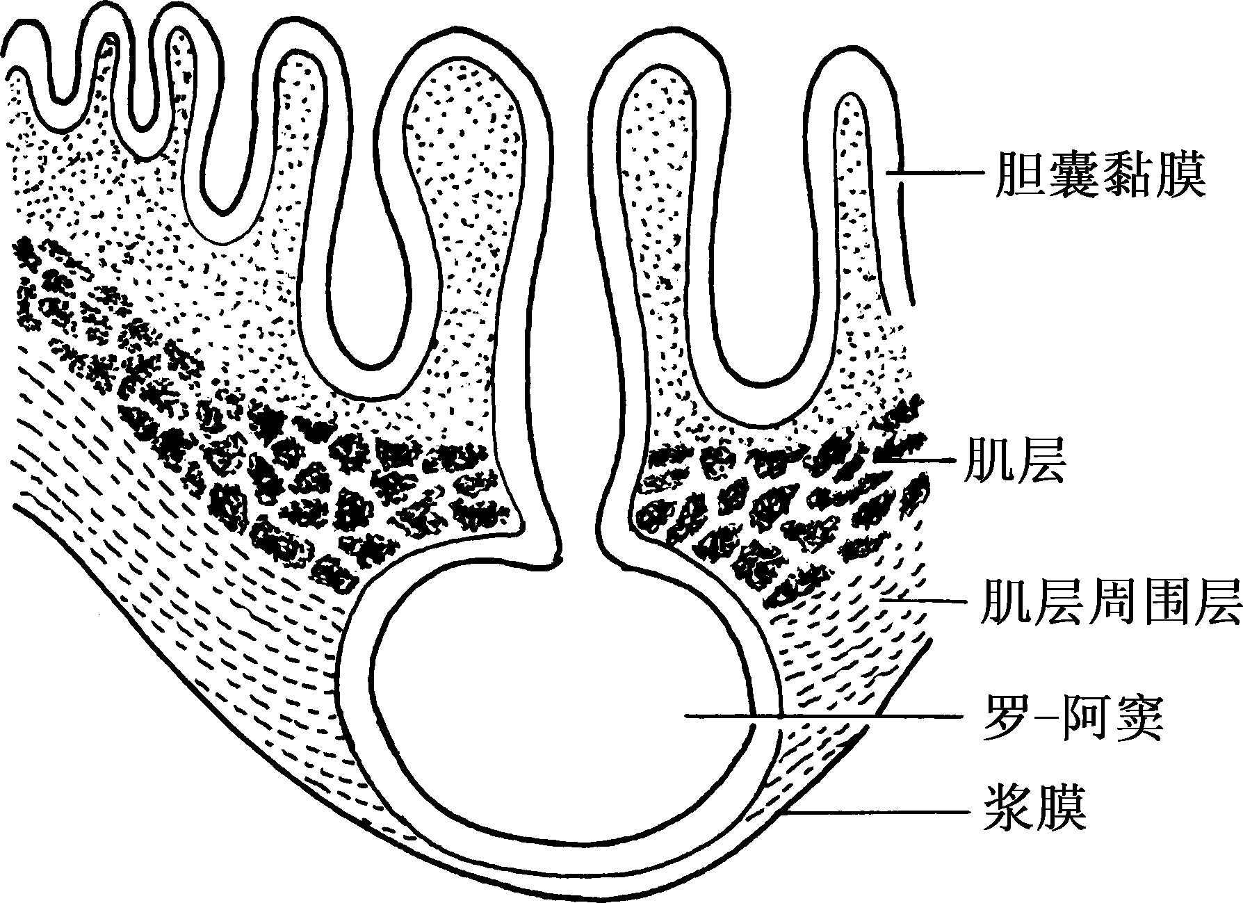 图2-6 胆囊结石声像图-腹部超声简易-医学
