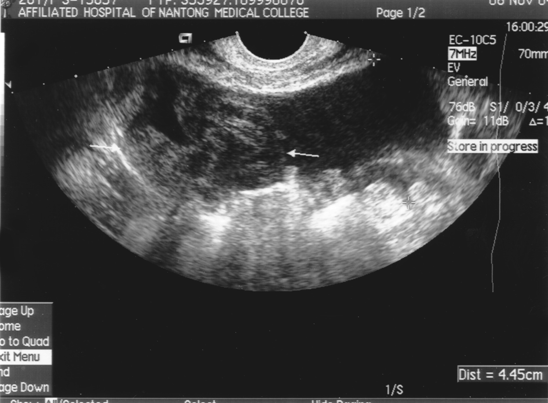 图2-121 输卵管的位置-妇产科临床解剖学-医学