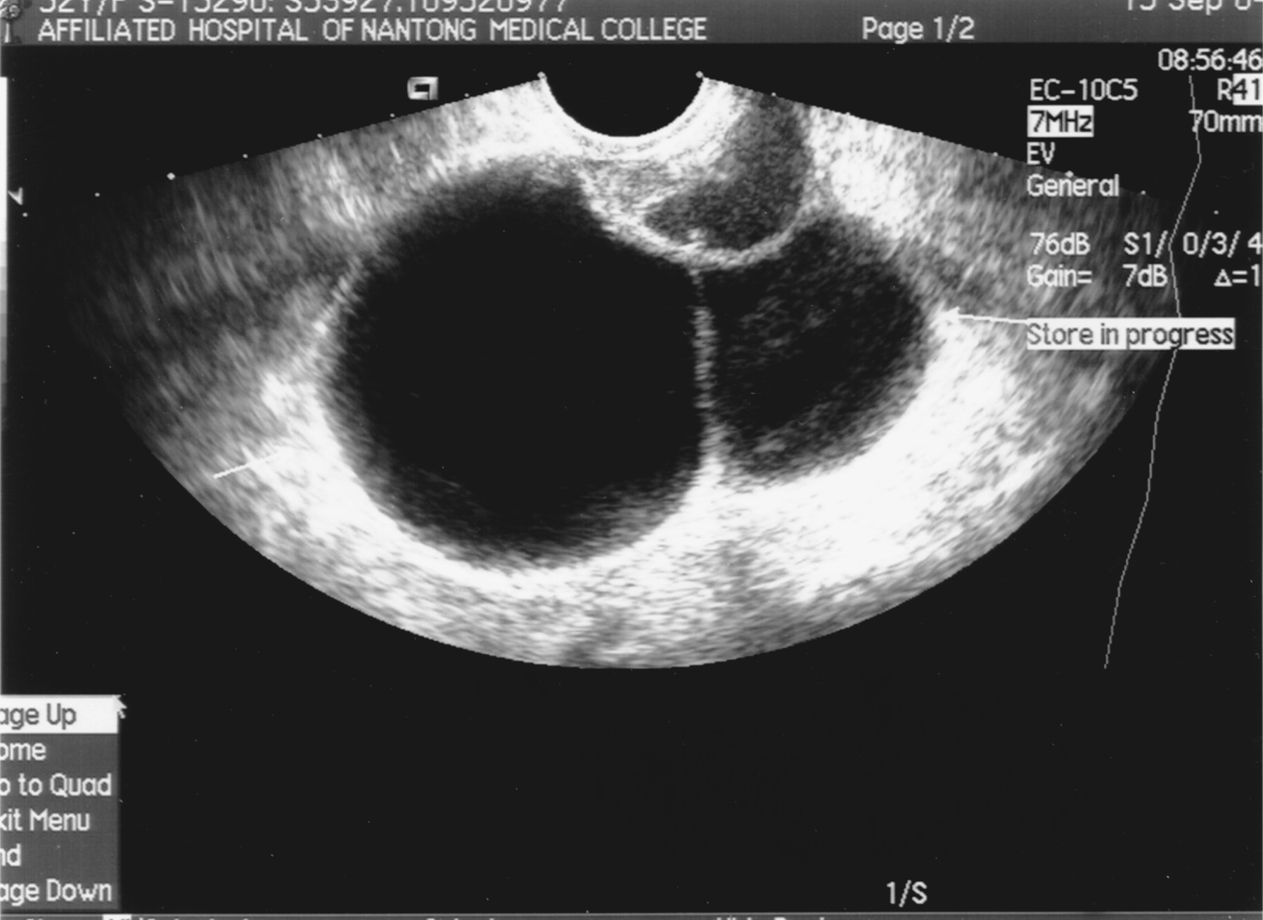 典型超声图像：卵巢巧克力囊肿-MedSci.cn