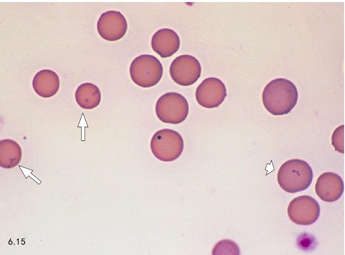 图77 遗传性球形红细胞增多症血象-血液学细胞学-医学