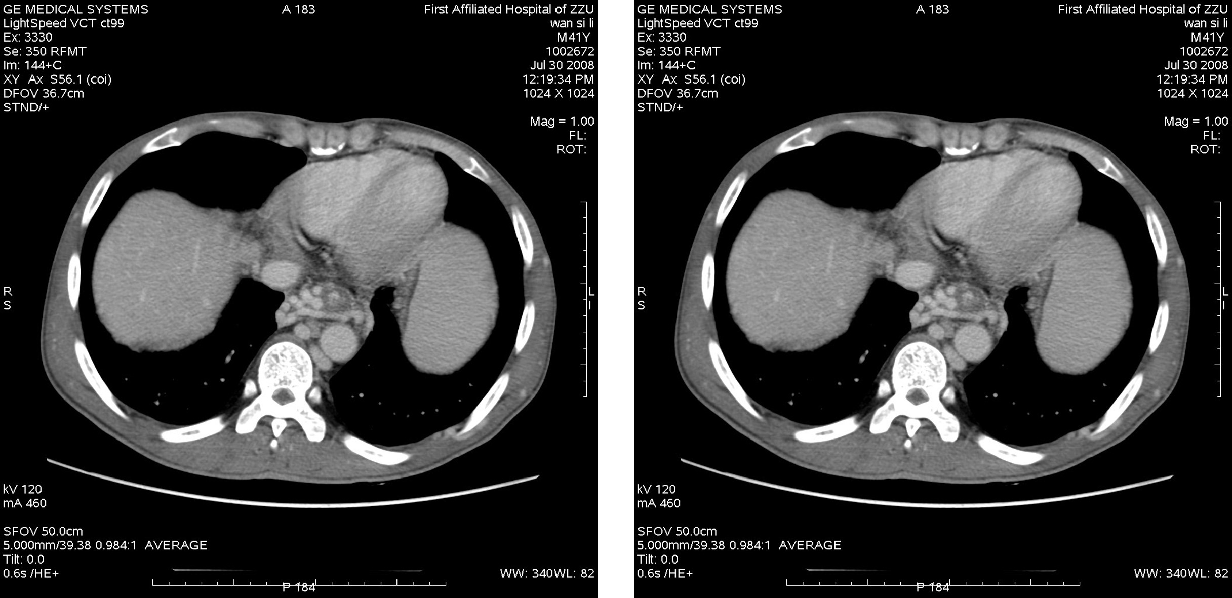 图7-24 第二肝门的CT图像-腹部外科临床解剖学-医学