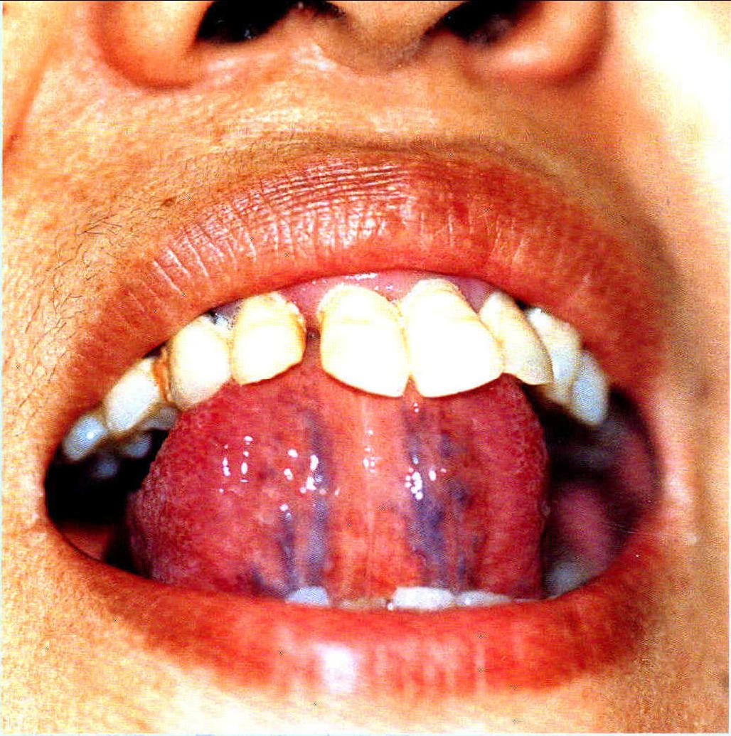 从零开始学中医：望舌下络脉 - 哔哩哔哩