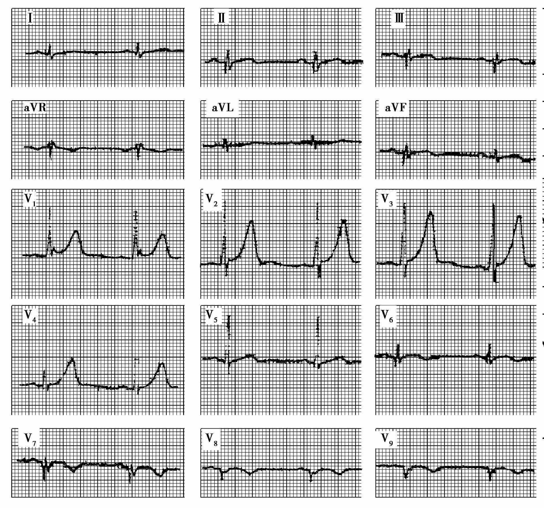 心电图常规导联无典型梗死波形的特殊部位心肌梗死