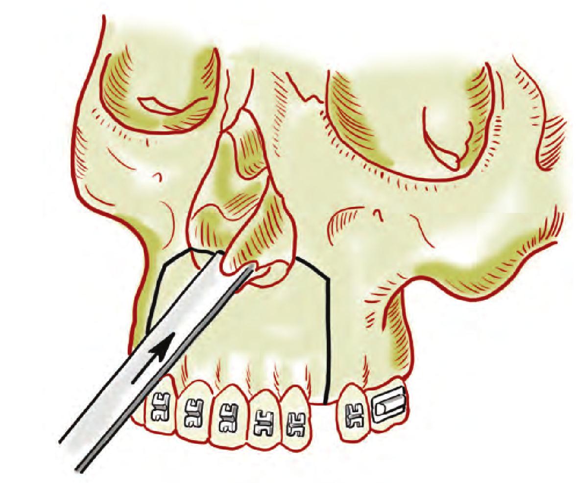 牙槽突裂髂骨松质骨植骨术的效果及影响因素分析