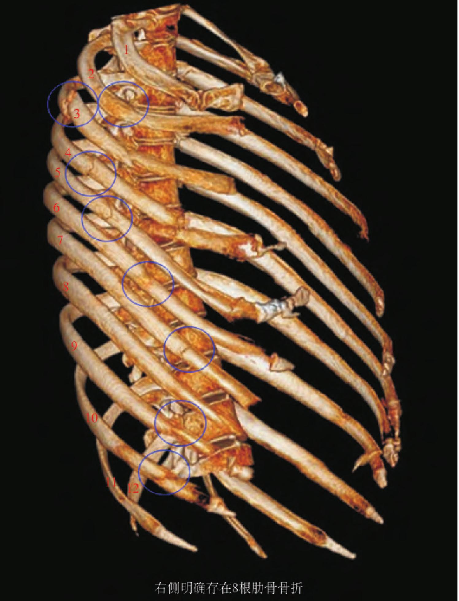 「肋骨骨折と解剖」理学療法士 田代雄斗 先生のコラム - 解剖実習アカデミー