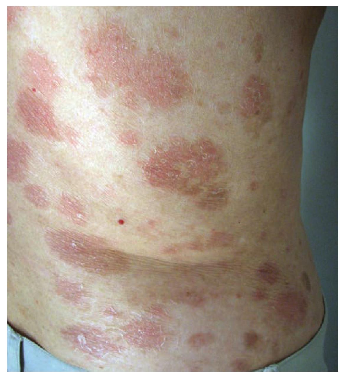 男性手上的寻常型银屑病有斑块、皮疹和斑块，孤立在白色背景上。自体免疫的基因疾病。照片摄影图片_ID:169843240-Veer图库