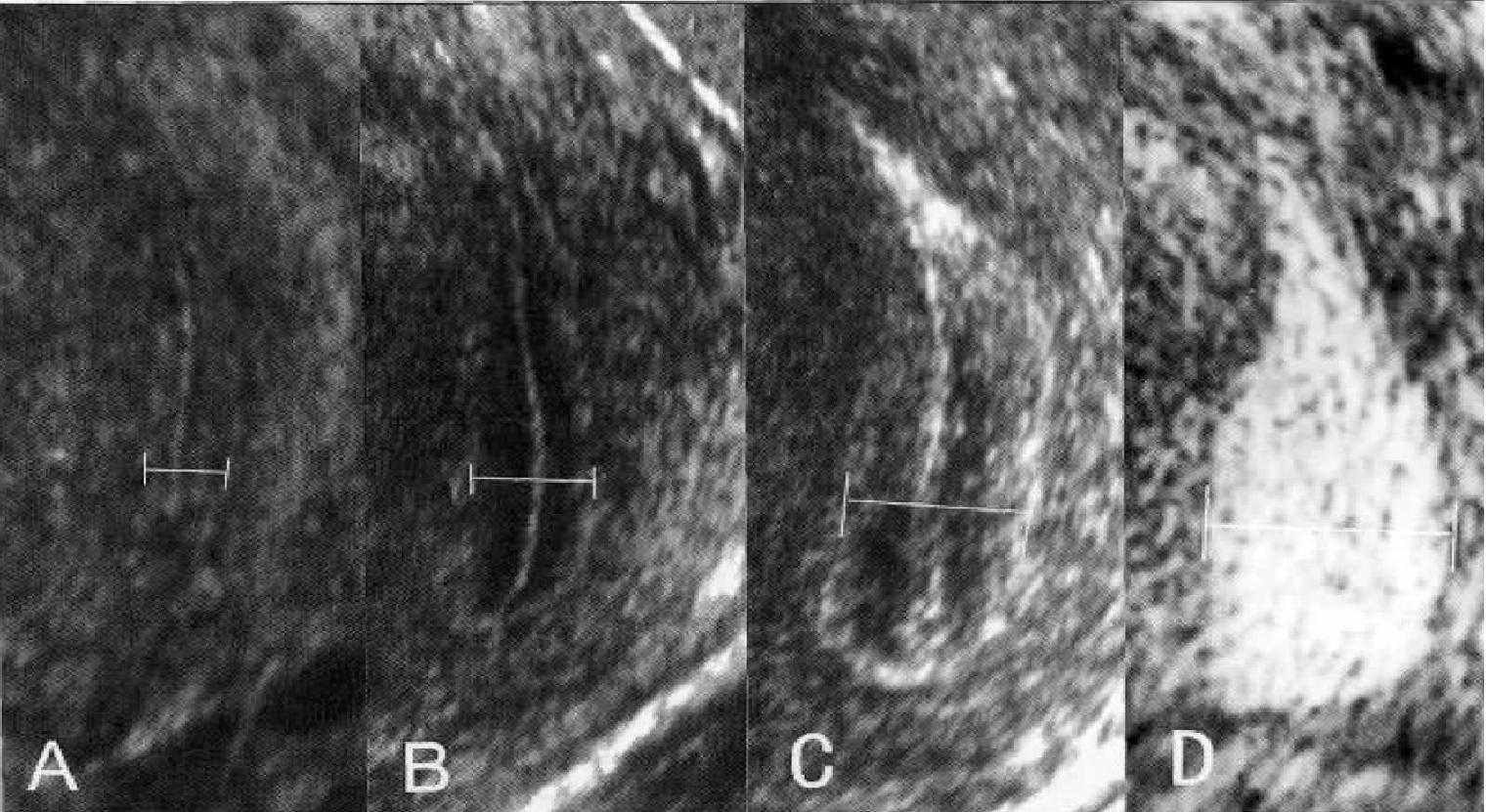 图2-49 子宫腔的形态(冠状切面)-妇产科临床解剖学-医学