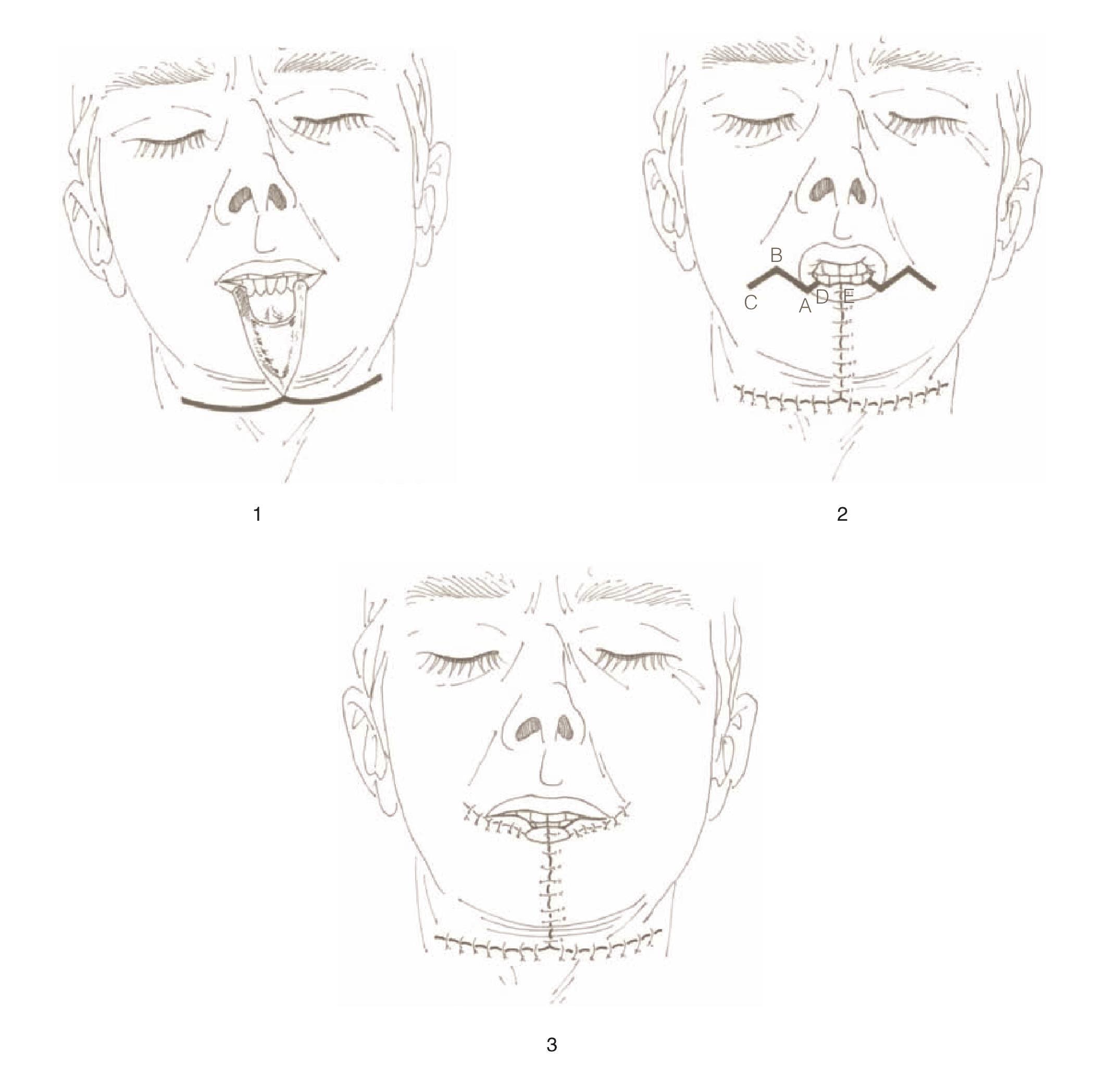 二、局部皮瓣法修复鼻部分缺损-外科学-医学