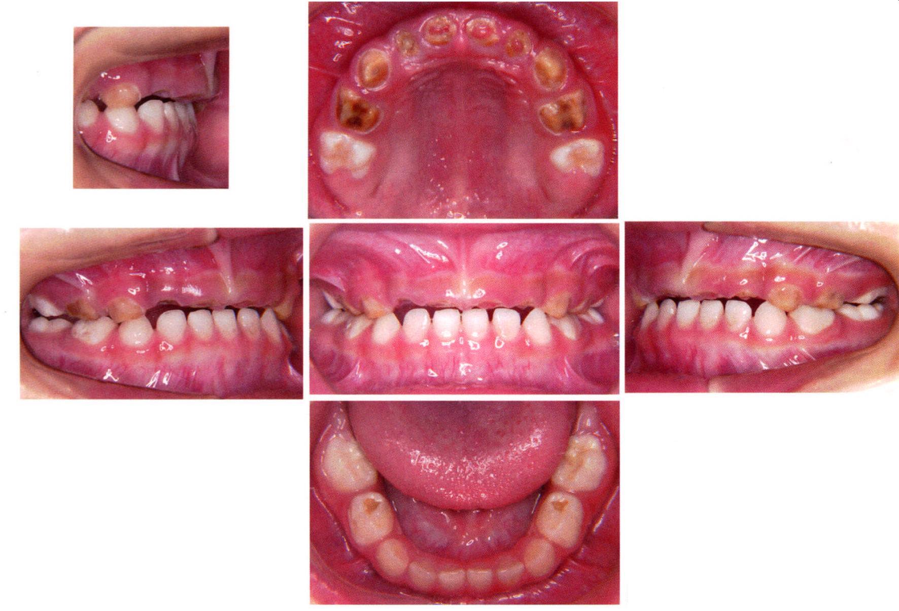 4) 第一磨牙萌出部位呈等差数列样显著的生长发育特点-混合牙列期咬合-医学