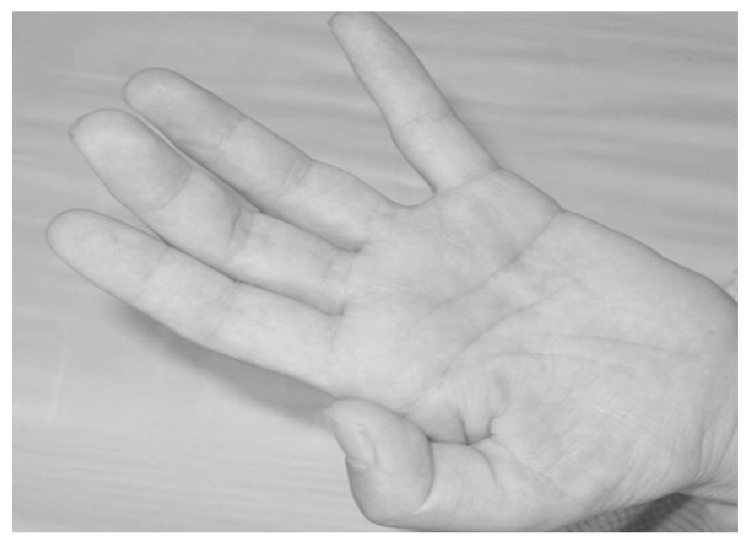 22岁小伙双手肌肉萎缩，珠海求医发现竟是因为这种罕见病！