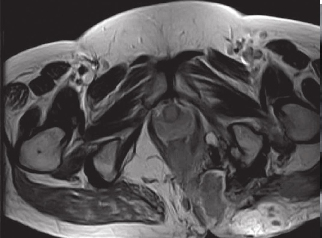 18.3 病例分析-肛管直肠周围疾病MRI-医学