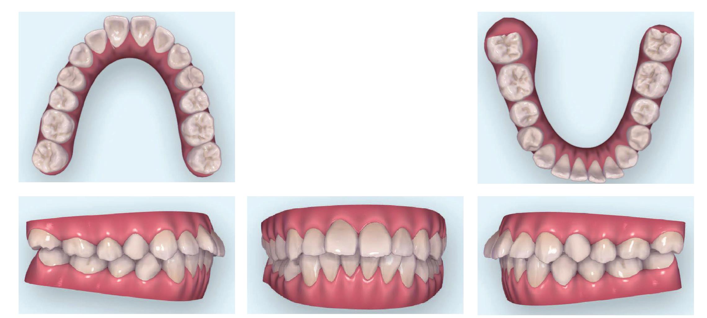 青岛牙齿矫正|「牙齿前突」案例：如何通过正畸让面部线条更加精致？ - 知乎