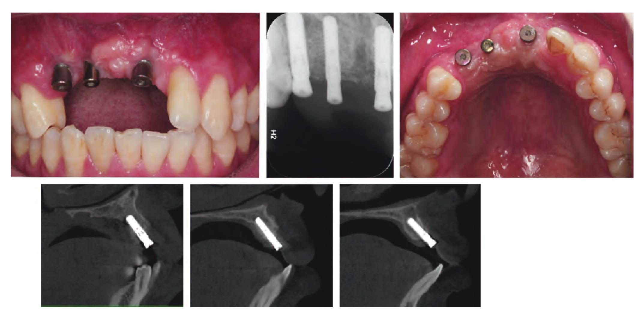 植牙的過程中，爲什麽需要補人工骨粉呢？ | 板橋安信牙醫診所